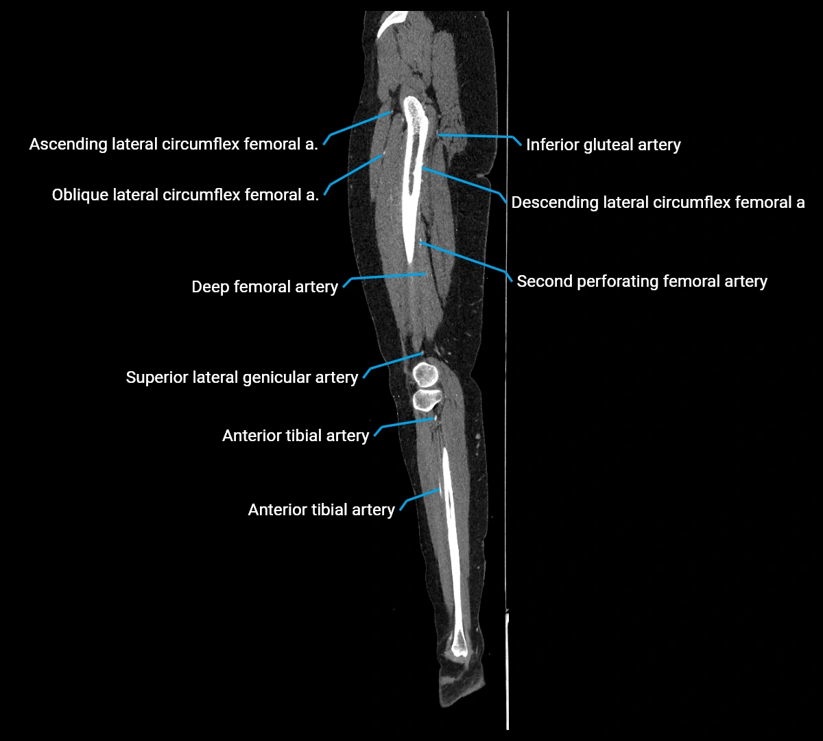 CTA lower limb sagittal cross sectional anatomy labelled image _54 (3).webp